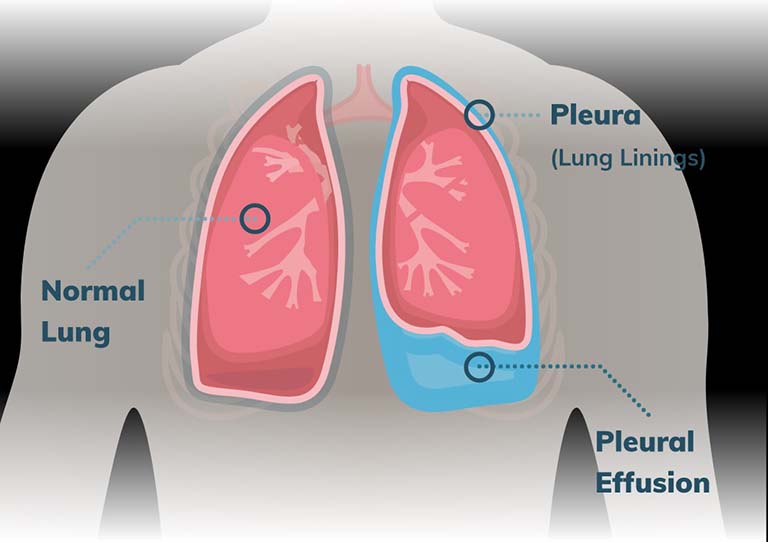 tràn dịch màng phổi là gì