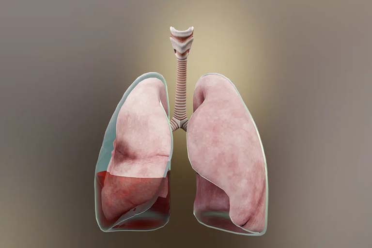 Cách điều trị tràn dịch màng phổi