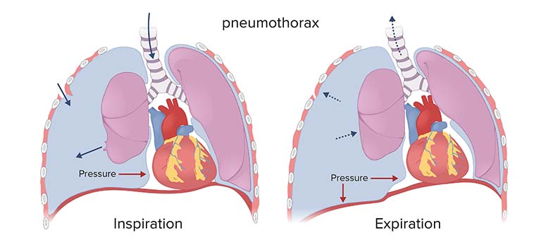 tràn khí màng phổi