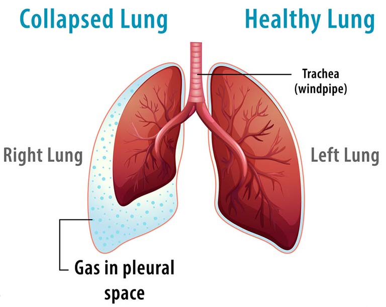 Nguyên nhân tràn khí màng phổi