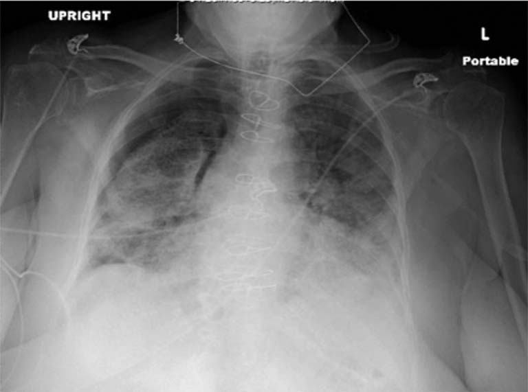 tràn khí màng phổi triệu chứng