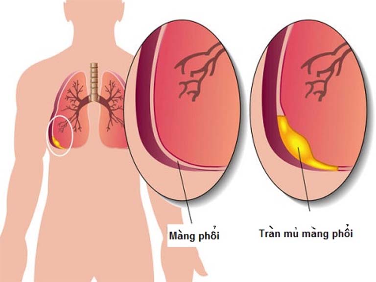 viêm mủ màng phổi