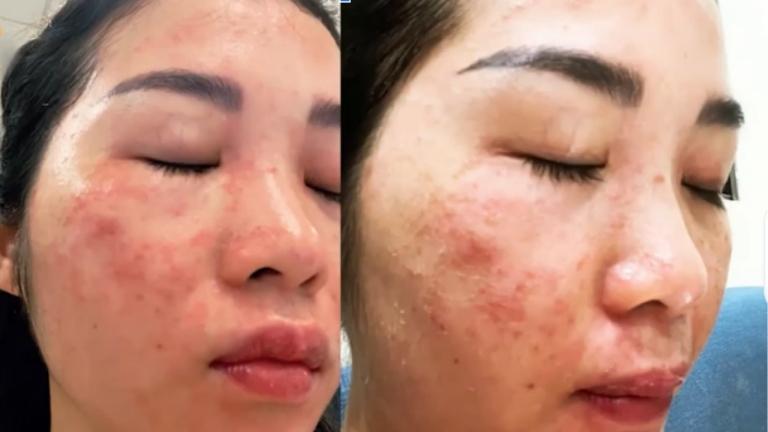 Làn da của chị Trang bị tổn thương nghiêm trọng do laser sai cách