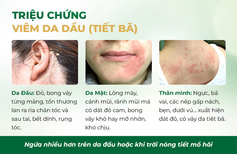 Triệu chứng viêm da dầu