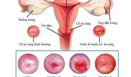 Hình minh họa viêm lộ tuyến qua các cấp độ