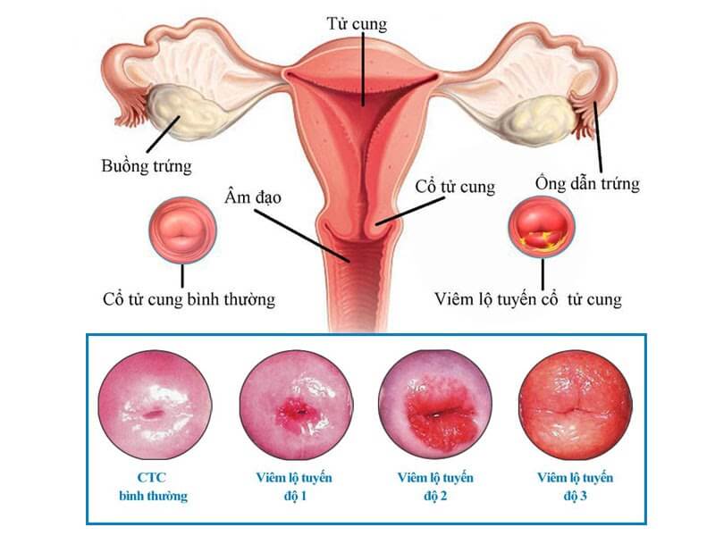 Hình minh họa viêm lộ tuyến qua các cấp độ