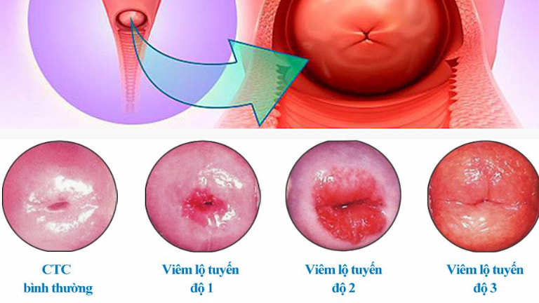 Hình ảnh viêm lộ tuyến các cấp độ