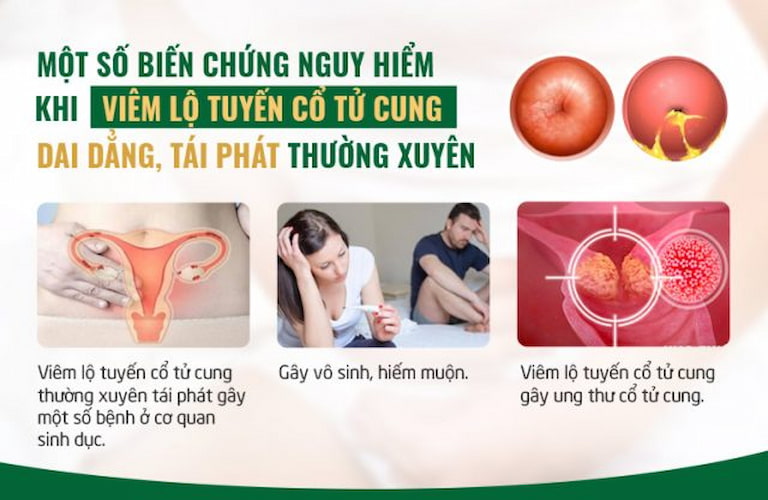 Biến chứng nguy hiểm của viêm lộ tuyến cổ tử cung